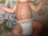 asymetria ułożeniowa u dziecka z torbielem w mózgu oraz po dwóch krwiakach